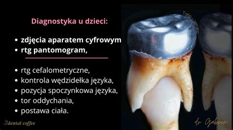 Planowanie ekstrakcji mleczaków w kontekście zgryzu Dental Coffee