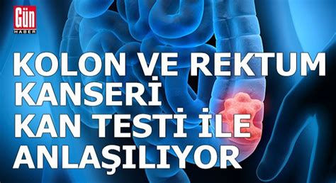 Gizli Kan Testi Ile Kolon Ve Rektum Kanseri Anla Labiliyor