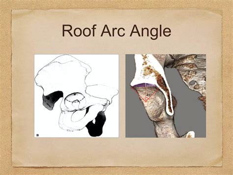 Acetabular Fracture Radiology: Xrays, CT scan & 3D printing | PPT