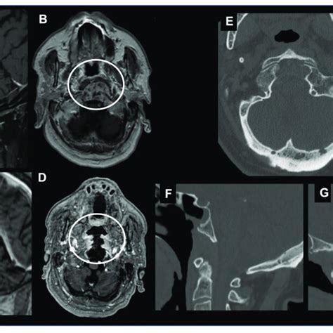 Combined Endoscopic Endonasal Approach And Far Lateral Transcondylar