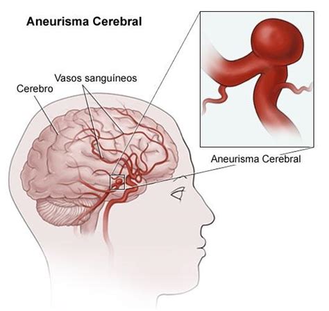 Cuáles son las causas del aneurisma cerebral 5 pasos