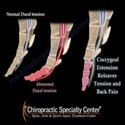 Coccyx Pain, Coccydynia & Tailbone Pain Treatment