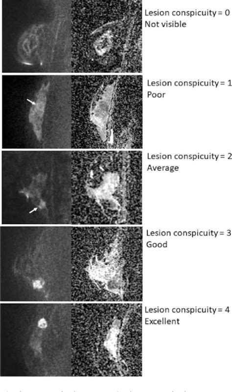 Figure 1 From Evaluation Of Malignant Breast Lesions Using High