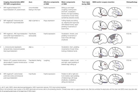 Frontiers The Anatomo Electrical Network Underlying Hypermotor Seizures