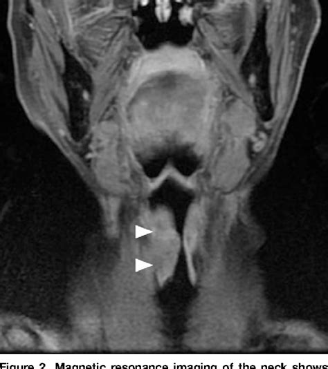 Visual Diagnosis In Emergency Medicine Steeple Sign Not Specific For