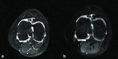 Anatomical And Diffusion Imaging Of The Knee In An Year Old Female