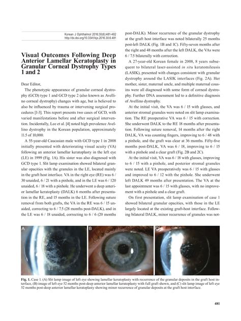 Pdf Visual Outcomes Following Deep Anterior Lamellar Keratoplasty In Granular Corneal