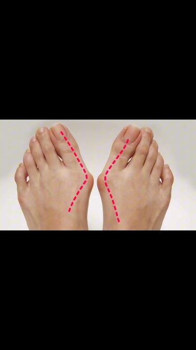 Информация о ХАЛЮС ВАЛЬГУС #barefoot #вальгус #здоровье #плоскостопие ...
