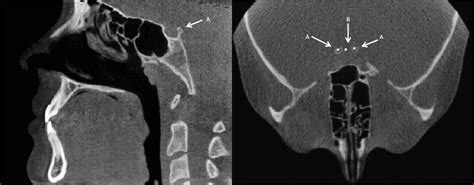 A Superior Right And Left Clinoid Processes In The Axial And Sagittal Download Scientific