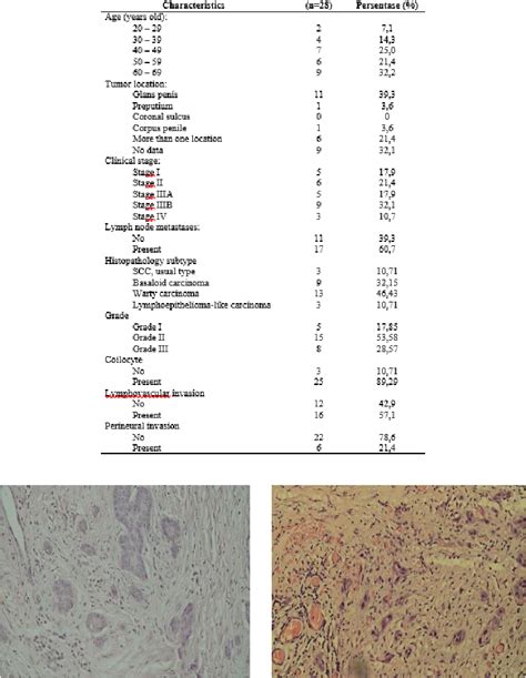 Table 1 From Tumor Budding Peritumoral Assessment As A Lymph Node Metastatic Prediction Of