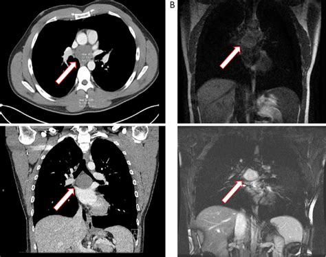 Posterior Mediastinal Bronchogenic Cyst Subcarinal Bronchogenic Cyst