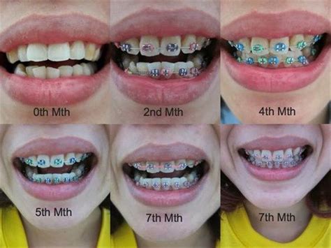 Month Braces