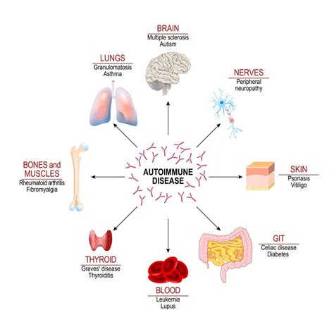 Symptoms Of Autoimmune Disease | Pompa Program