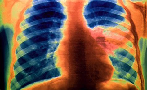 Mycoplasma Pneumonia Chest X Ray Findings Taperilly