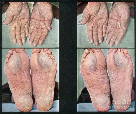 Palmoplantar Keratoderma Vintage Photograph By Doublevision