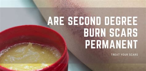 Are Second Degree Burn Scars Permanent Treat Your Scars