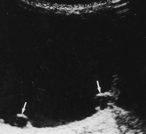 “daughter Cyst” Sign A Sonographic Finding Of Ovarian Cyst In Neonates