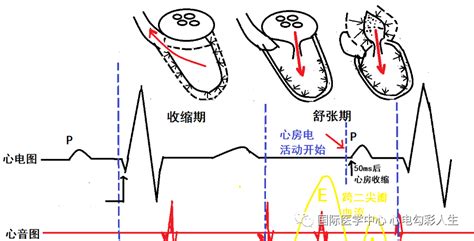 心电图如何判定房室不同步 西安国际医学中心医院 心脏病医院