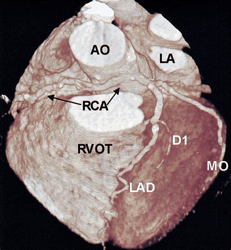 Coronary Angiography With Multi Slice Computed Tomography The Lancet