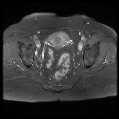 Hydrosalpinx (MRI) | Image | Radiopaedia.org