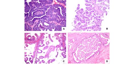 Composite Of Prostatic Adenocarcinomas With Papillary Architecture A Download Scientific