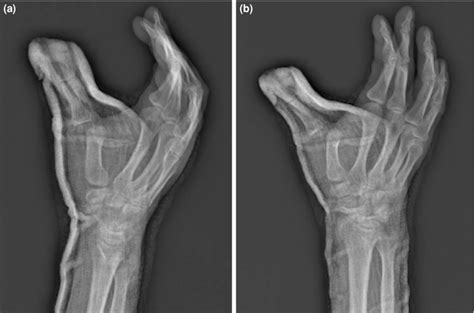 First post-reduction radiographs showing that the (a) first ...