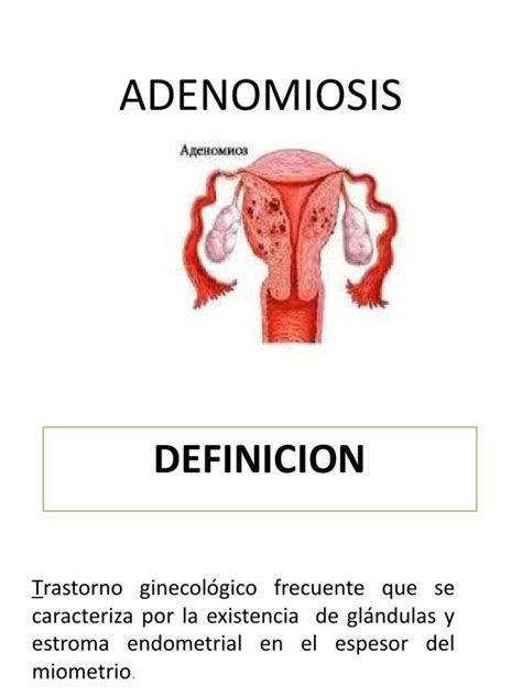 Comprehensive Overview Of Adenomyosis Definition Symptoms Diagnosis