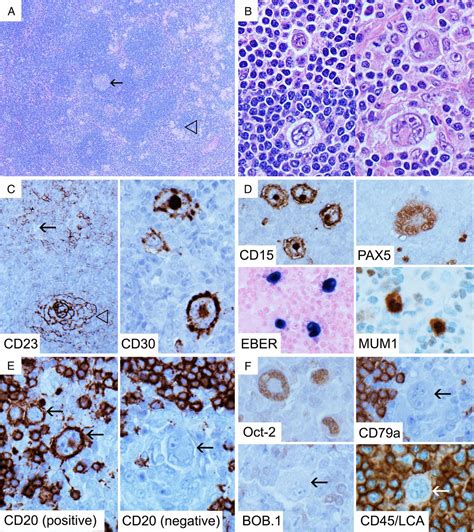 T Cell Rich Lymphoid Infiltrates With Large B Cells A Review Of Key Entities And Diagnostic