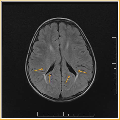 Periventricular leukomalacia: MRI - Sumer's Radiology Blog