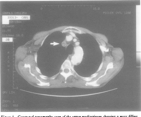 Figure 1 From Intimal Sarcoma Of The Right Brachiocephalic Vein