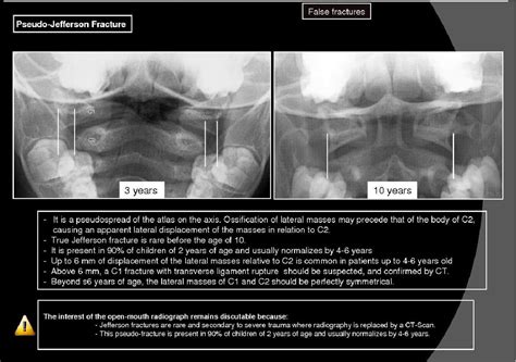 Figure 1 From Radiographic Atlas Of Pediatric Cervical Spine In