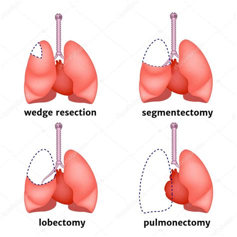 Tipos de resección pulmonar Extracción de un órgano o sus partes