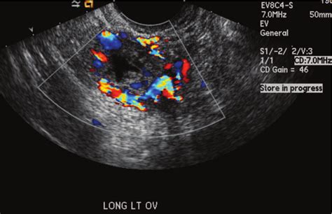 Ruptured Ectopic Pregnancy Ultrasound