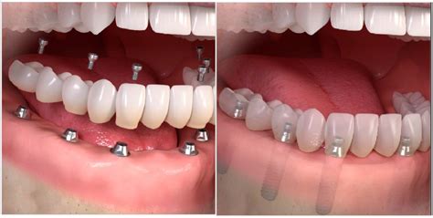 Implantes dentales Implantología Dental Abad