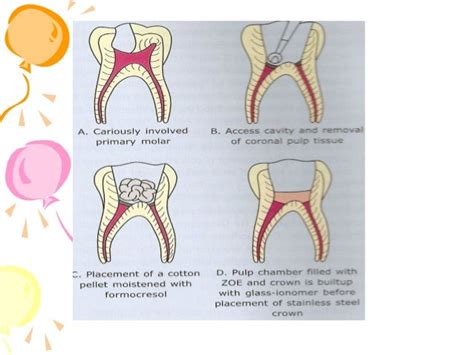 Pulp Therapy In Pediatric Dentistry