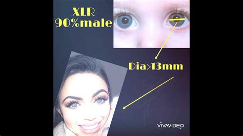 Megalocornea in a minute - YouTube