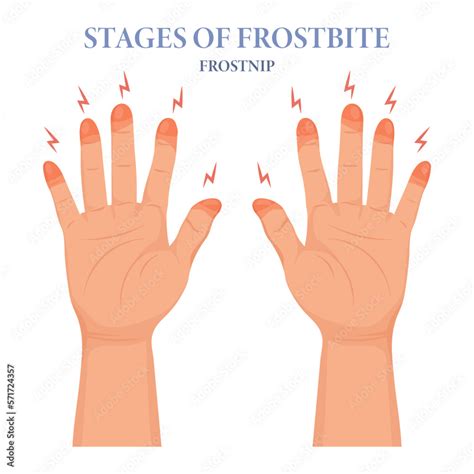 refrigerant burn fingers  gwen mayer blog