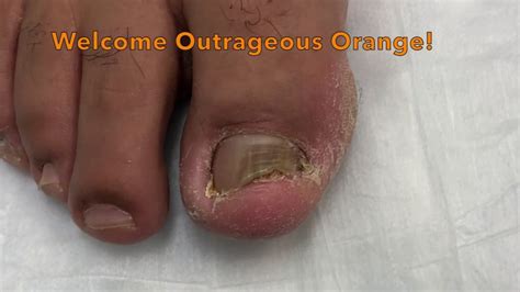 Patreon Fungal Toenail Removal 1 Youtube