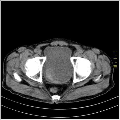 Radiopaedia Case Urinary Bladder Hematoma Id 59790 Study 67220 NC