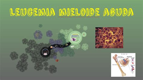 Leucemia Mieloide Aguda By Noelia Gil Rodr Guez On Prezi