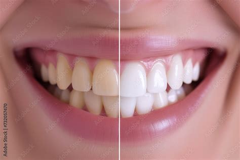 Close Up Split Image Showing The Before And After Results Of Teeth Whitening Treatment The Left