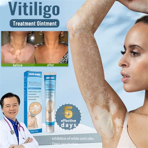 Vitiligo Treatment Cream Atoderma Cream Original Vitiligo Remover