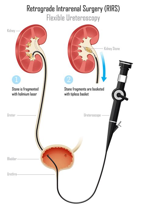 Endoscopic Surgery Urology