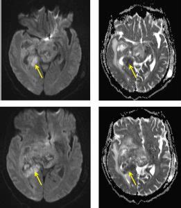 Glioblastoma Multiforme Radiology Cases