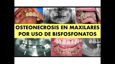 Osteonecrosis De Los Maxilares Por Uso De Bisfosfonatos Youtube