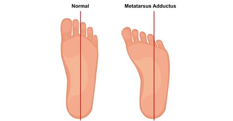 Podiatry Clinic in Singapore for Metatarsus Adductus