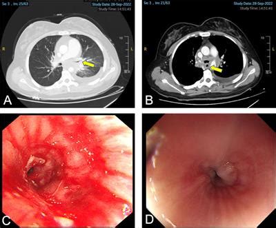 Frontiers Case Report A Case Of Recurrent Cervical Cancer With