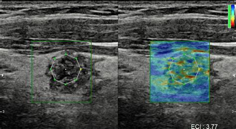 Multiparametric Ultrasound And Ai Of Papillary Carcinoma [oct 2022