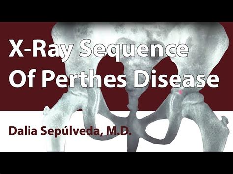 X-Ray Sequence Of Perthes Disease - Global HELP