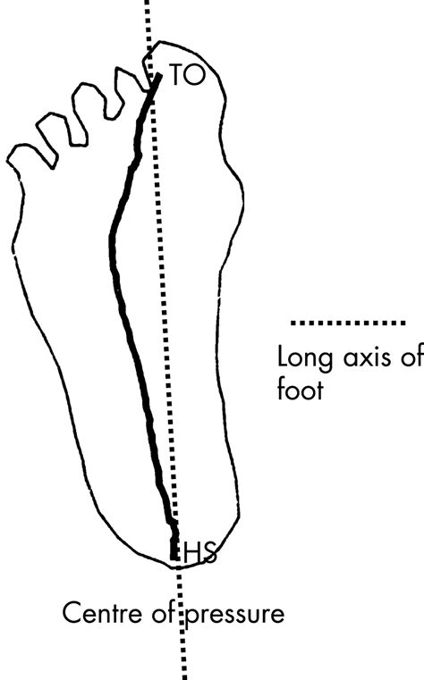 The Relationship Between Toe Out Angle During Gait And Progression Of